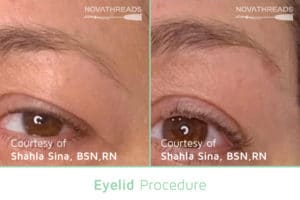 Before After eyelid 1
