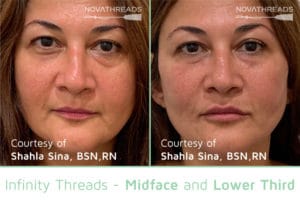 Before After midface 12