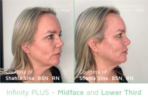 Before After midface 16