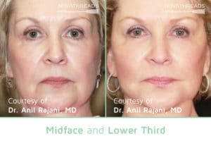 Before After midface 9