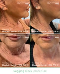 Before After neck 3 big