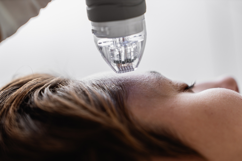 Microneedle,Rf,Lifting,Procedure.,Hardware,Cosmetology.,High,Quality,Photo
