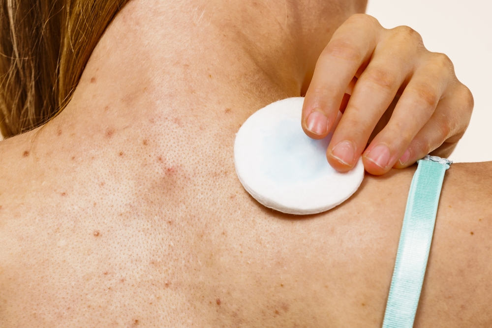 Treatment,For,Adult,Acne,Problem.,Woman,With,Red,Spots,On