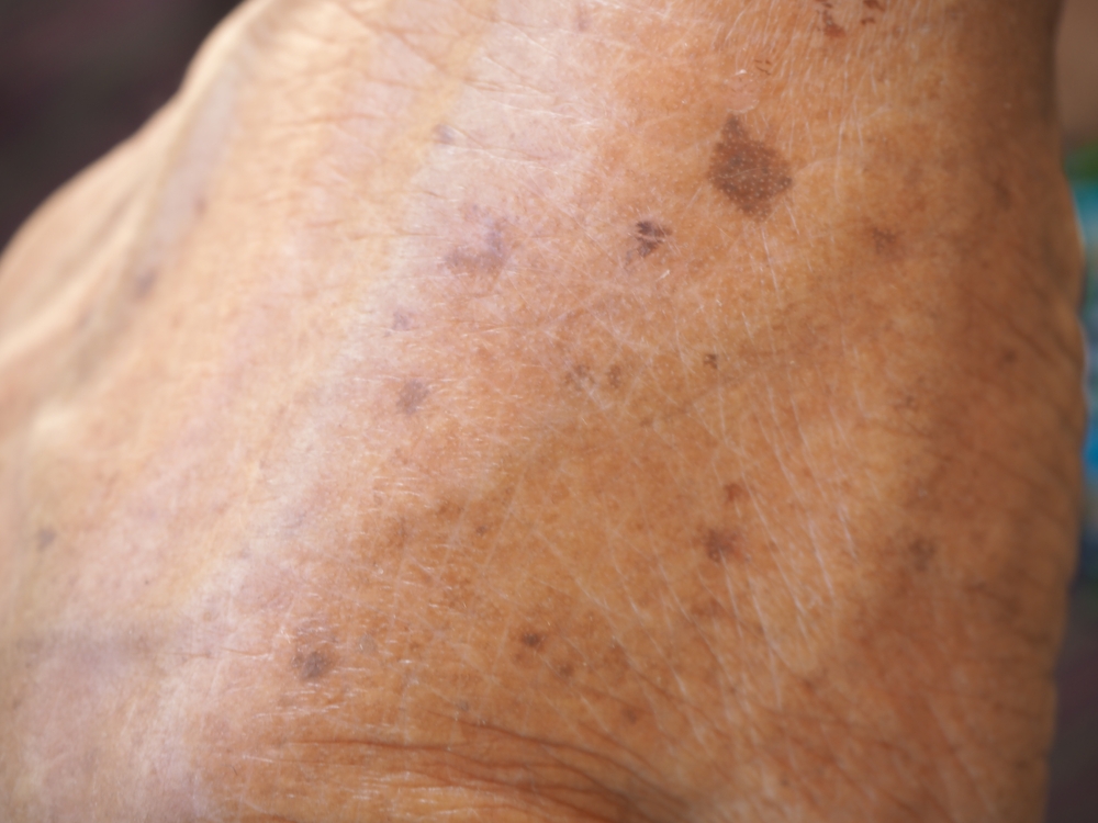 Skin,Cancer,Or,Melanoma,On,Hand,Type,Of,Superficial,Spreading