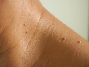 Close up,The,Skin,Tags,On,Neck,Man,Skin.
