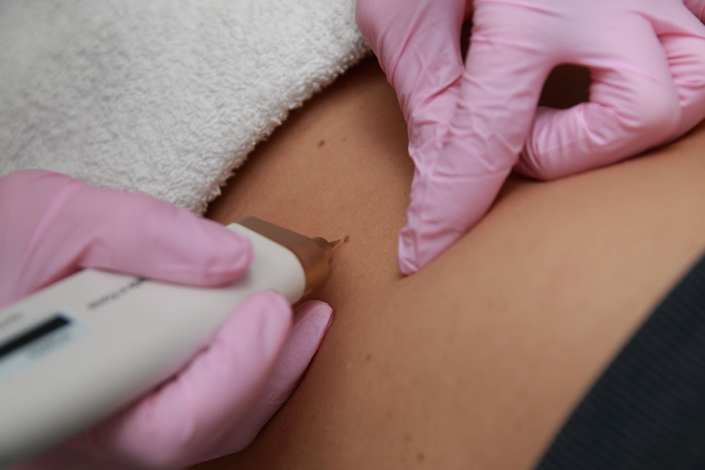 Removal,Of,Benign,Tumors,In,Cosmetic,Salon.,Laser,Skin,Tags
