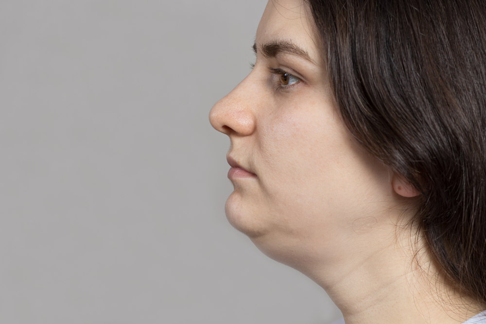 The,Woman,Has,A,Double,Chin.,Treatment,,Chin,Reshaping,,Fat