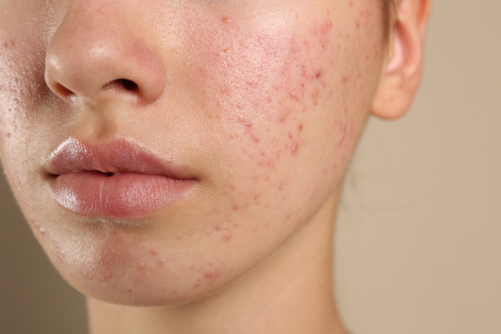 Teenage,Girl,With,Acne,Problem,On,Beige,Background,,Closeup