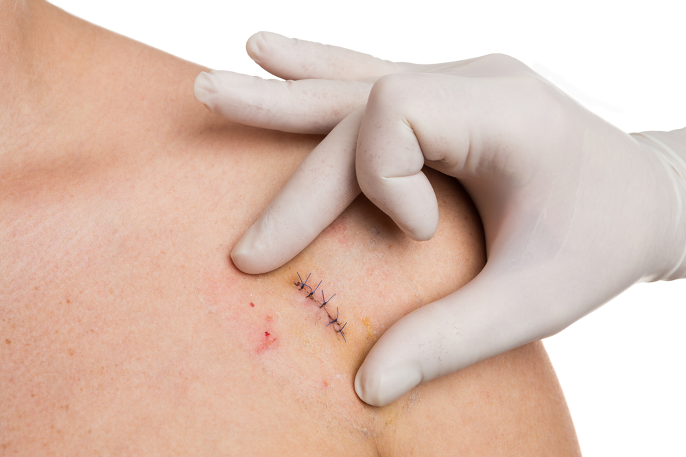 Doctor,Hands,Checking,Stitches,After,Mold,Removal,Surgery,On,Woman