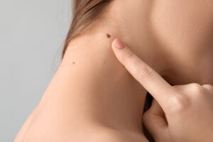 Woman,Pointing,At,Mole,On,Her,Neck,Against,Grey,Background,