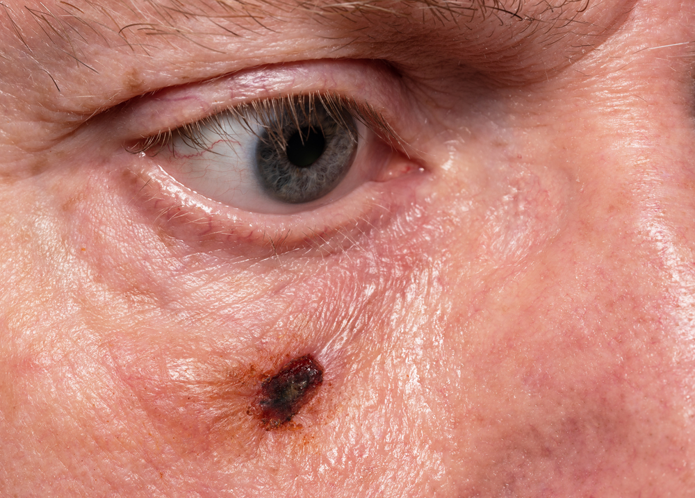 Wound,On,Causian,Male,Cheek,After,Removal,Of,Suspected,Skin