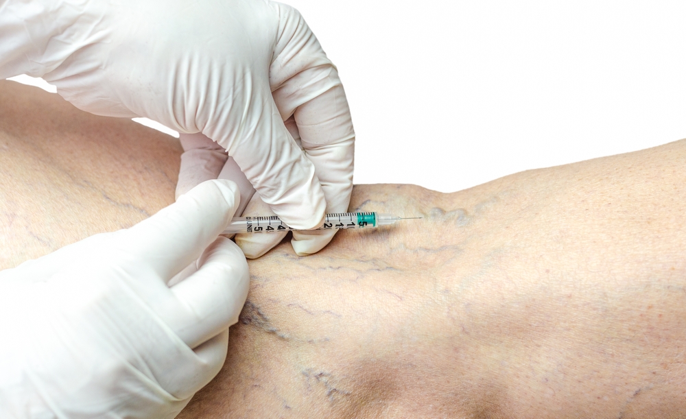Sclerotherapy,On,The,Legs,Of,An,Adult,Caucasian,Male.,Removal