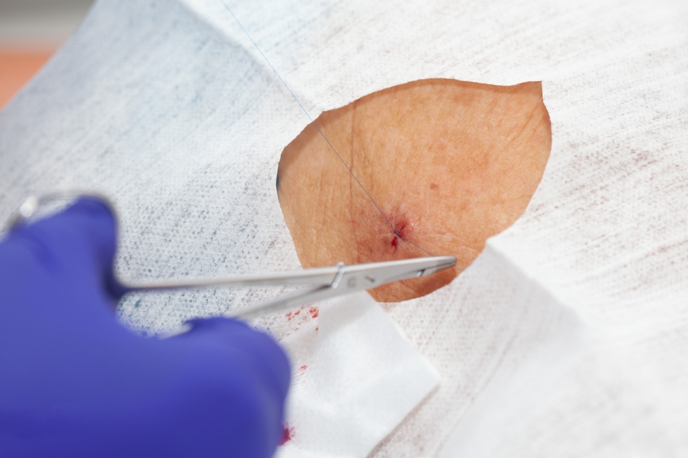 Doctor,Suturing,A,Patient,During,A,Small,Surgery.,Dermatologist,Carrying