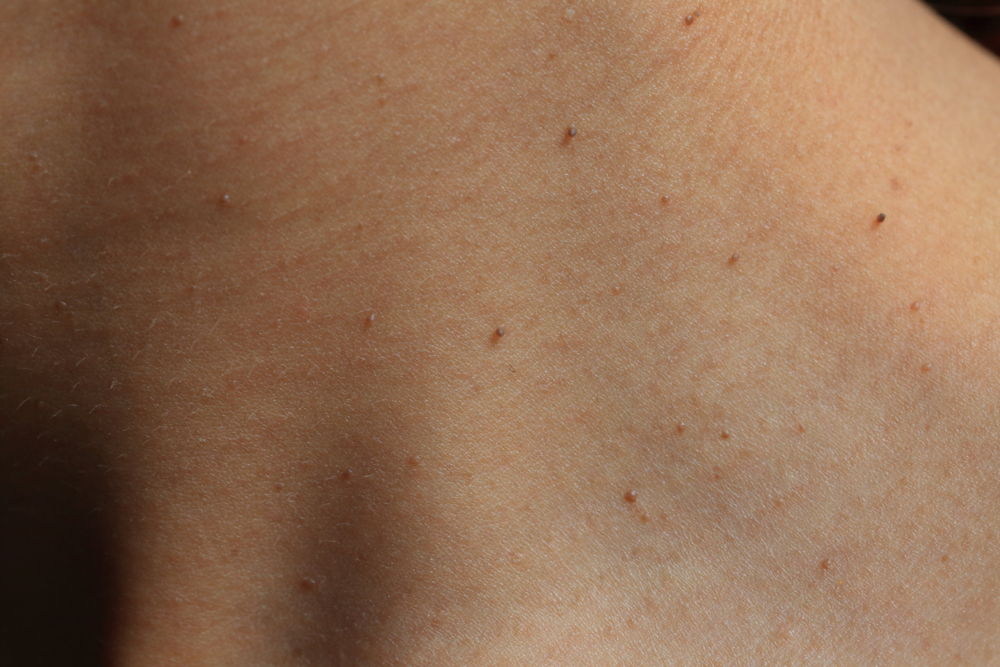 Seborrheic,Keratosis,On,Neck