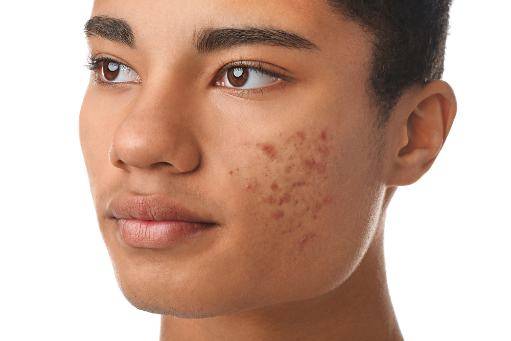 African american,Teenage,Boy,With,Acne,Problem,On,White,Background African american,Teenage,Boy,With,Acne,Problem,On,White,Background