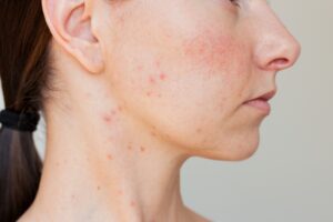 Close up,Profile,Of,A,Young,Woman,Suffering,Rosacea,In,Acute