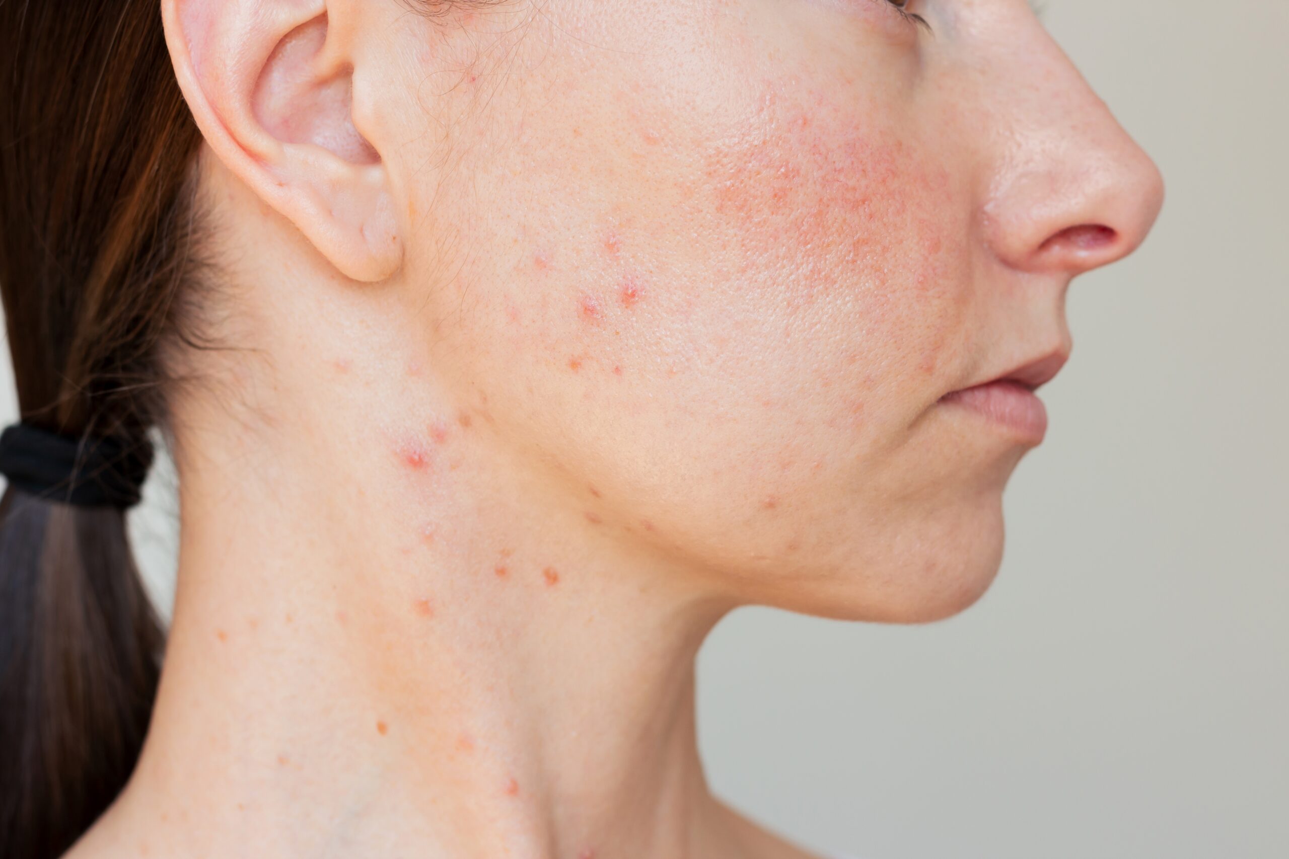 Close up,Profile,Of,A,Young,Woman,Suffering,Rosacea,In,Acute