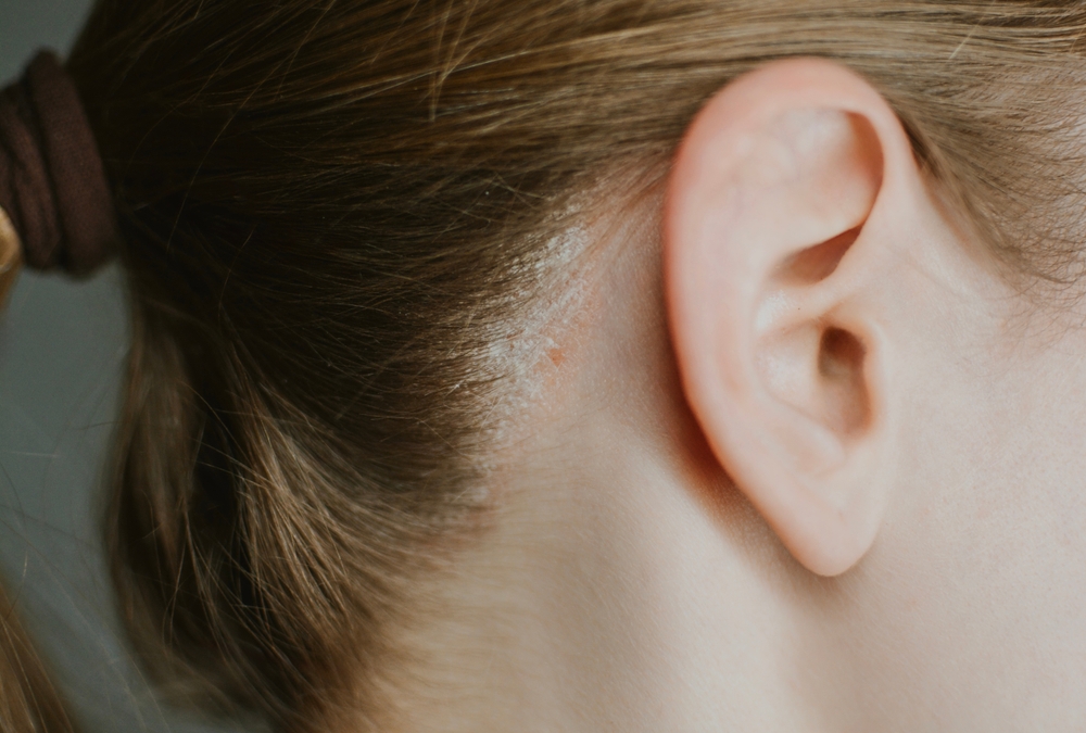 Psoriasis,On,A,Woman's,Head,Close up,With,Redness,And,Peeling.