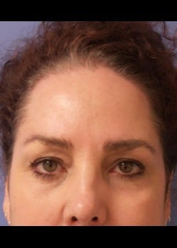 Eyelid Rejuvenation Case 1