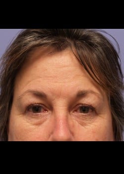 Eyelid Rejuvenation Case 2