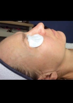 Chemical Peels Case 1