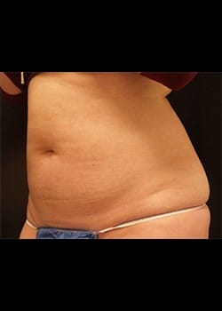 Coolsculpting Case 1