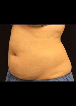 Coolsculpting Case 1