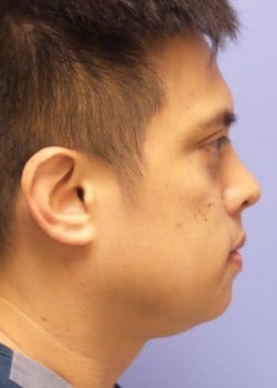 Kybella Case 1