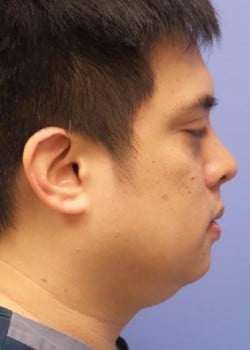 Kybella Case 1