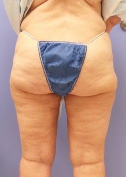 Liposuction Case 1