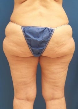 Liposuction Case 1