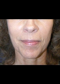 Sculptra Case 1