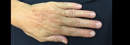 Restylane Filler for Hands