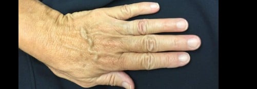 Restylane Filler for Hands