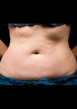 CoolSculpting Case 2