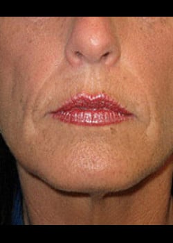 Sculptra Case 1