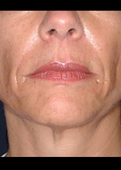 Sculptra Case 5