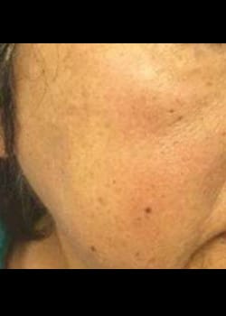 PiQo4 Laser Treatment Case 4