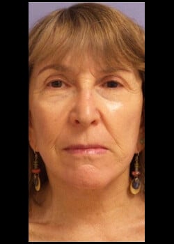 Facelift / Neck Lift Case 3