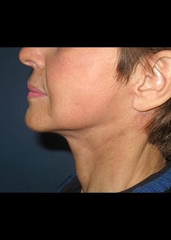 Facelift / Neck Lift Case 4