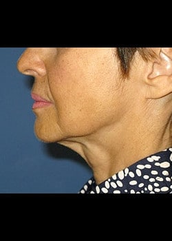 Facelift / Neck Lift Case 4