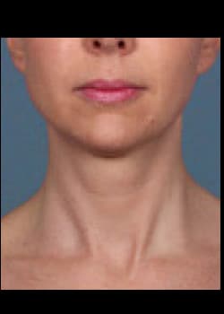 Kybella Case 3