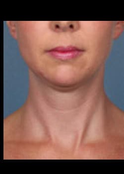 Kybella Case 3