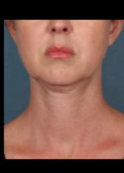 Kybella Case 4