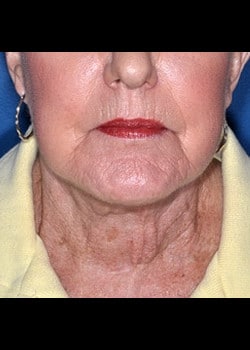 Facelift / Neck Lift Case 5