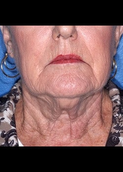 Facelift / Neck Lift Case 5