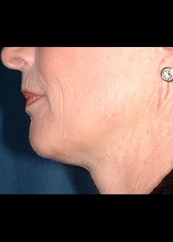 Facelift / Neck Lift Case 6