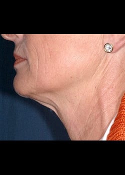 Facelift / Neck Lift Case 6