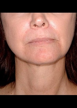 Facelift / Neck Lift Case 7