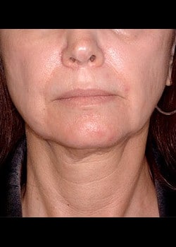 Facelift / Neck Lift Case 7